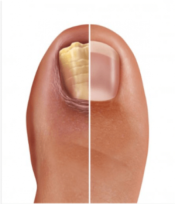 Tratamiento de Onicomicosis