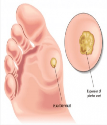 Tratamiento de Verrugas Plantares