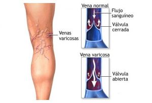 VARICES